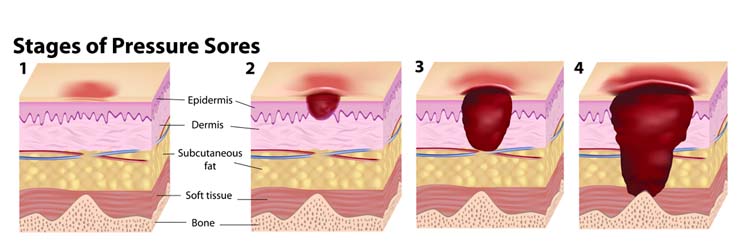 Stages of Pressure Ulcers