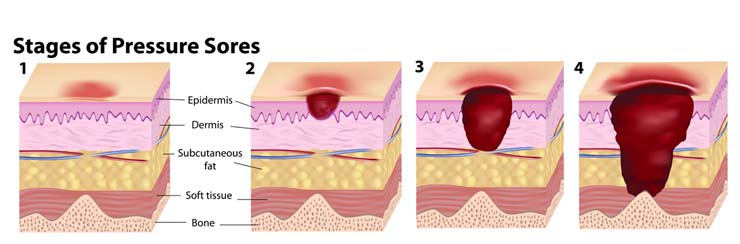 Pressure Ulcer Stage 1