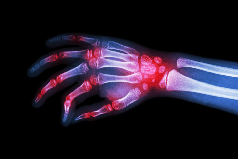 X ray scan with arthritis